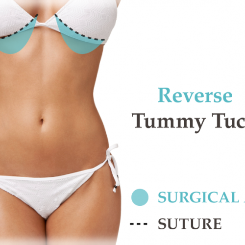 tummyTuck