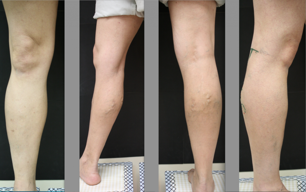 Comprehend The Peripheral Vein Infection Associated To Legs