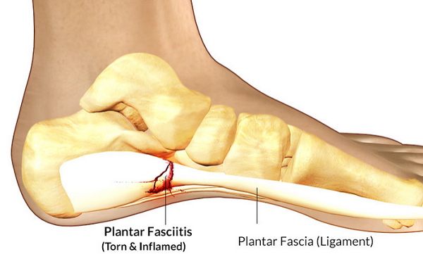 Heel Pain? Solutions For Plantar Fasciitis and Other Heel Pain Causes