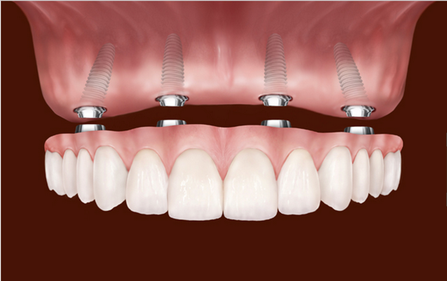 Top 5 Myths Associated With Dental Implants You Must Know