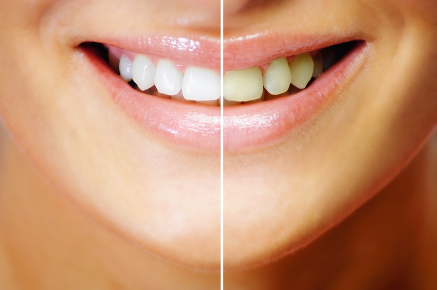 What You Should Know About Teeth Whitening Strips