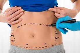 What You Need To Know About The Tummy Tuck Surgery